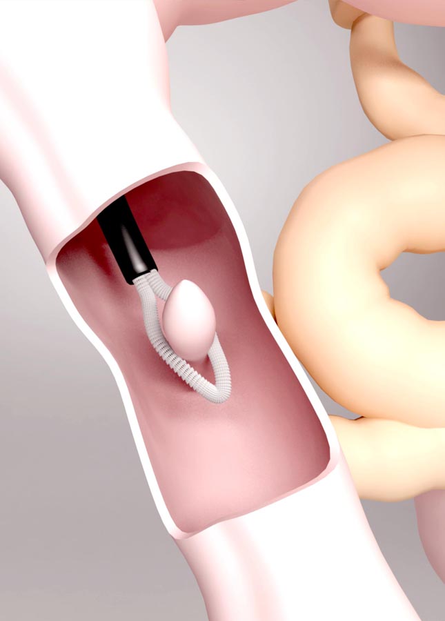 Endoscopia